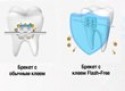 Как сохранить здоровую эмаль при ортодонтическом лечении?