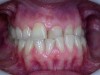 Диагноз: скелетная форма мезиального прикуса, патологическая стираемость и сколы эмали, адентия 27, 36, 37 и 46 зубов