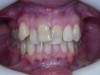 Дистальный прикус II (2) класс по Энглю, сужение верхнего зубного ряда, скученность во фронтальном отделе верхнего и нижнего зубных рядов.