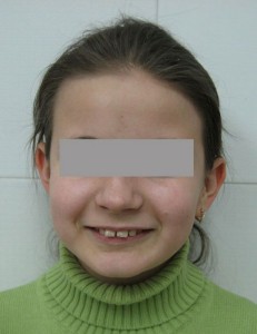Сужение и удлинение верхнего и нижнего зубных рядов, тремы во фронтальном отделе верхнего и нижнего зубных рядов (протрузия), глубокая резцовая дисокк